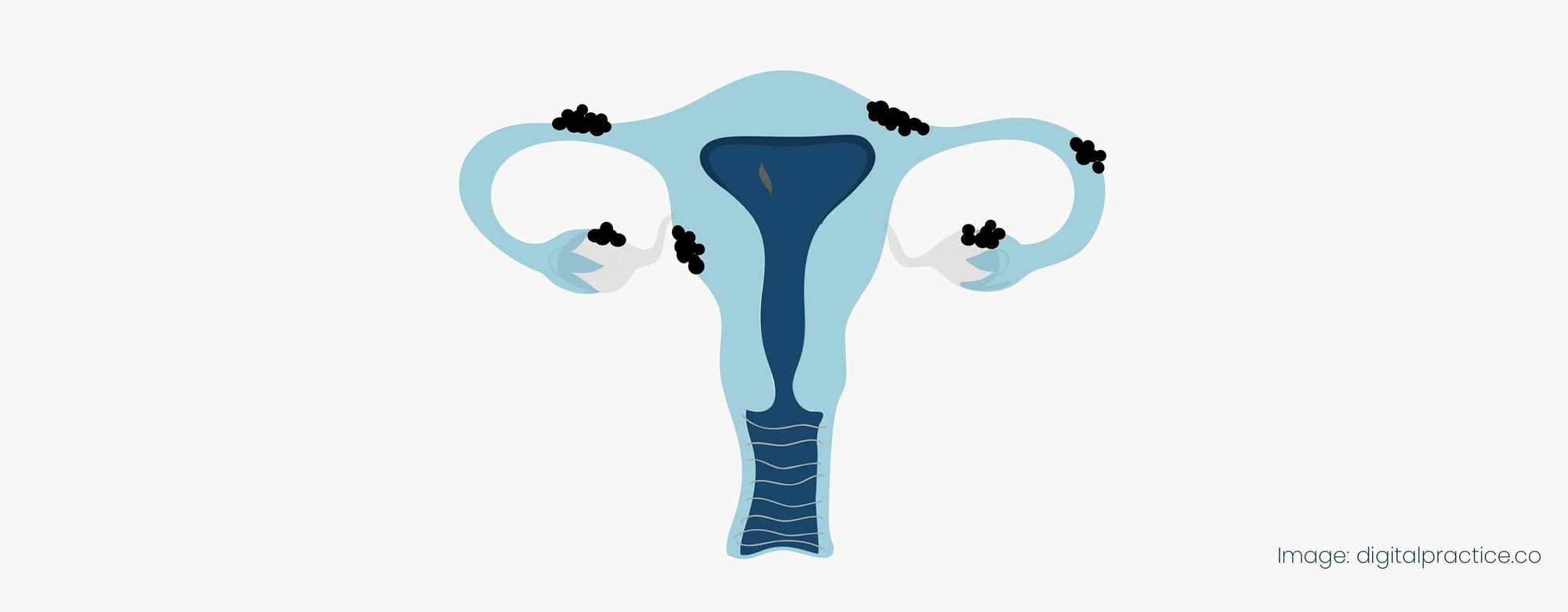 Endometriosis Perth - Dr Charles Armstrong, Gynaecologist